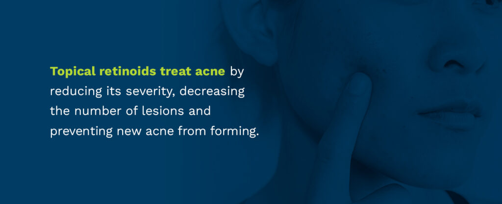 Topical retinoids treat acne